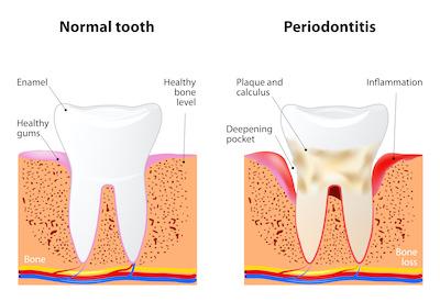 diagram showing healthy tooth and root system compared to one with peritonitis