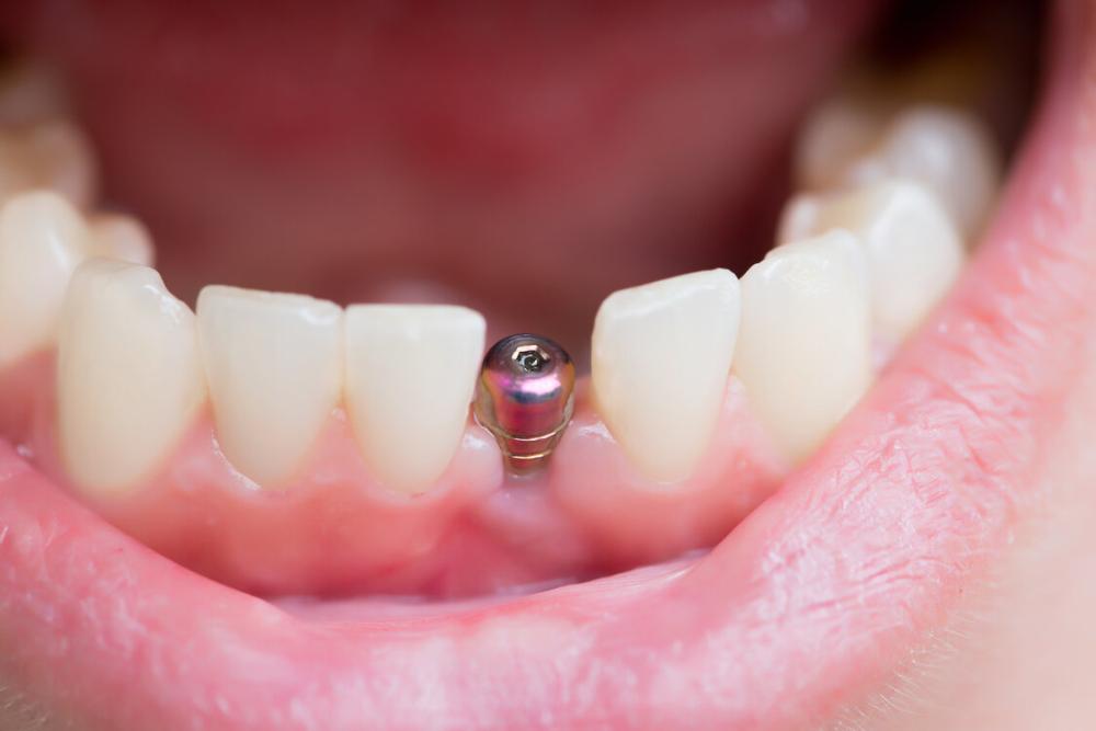 close up of dental implant in jaw