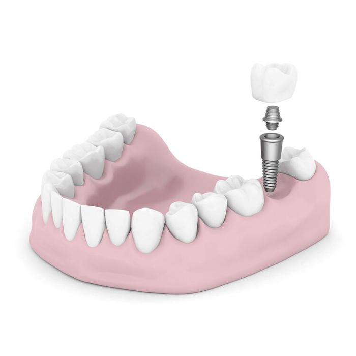 dental implant