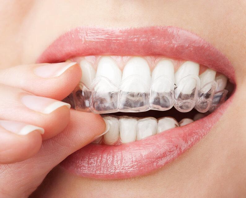 close up of woman using invisalign