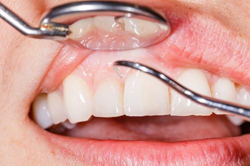 close up of dental tool working on gum