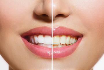 Before and after photo of teeth whitening