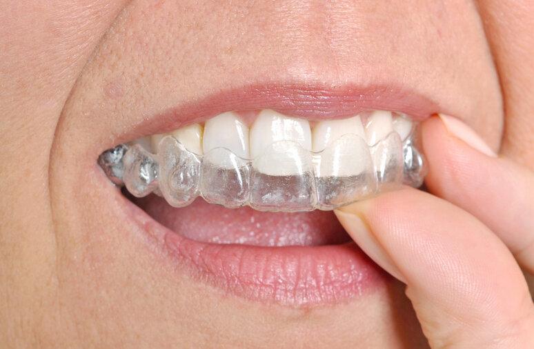 Close up of person using clear aligners