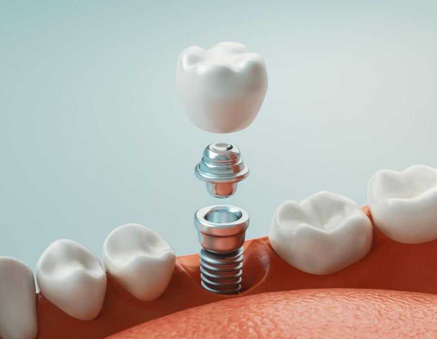 dental implant being put into lower jaw bone