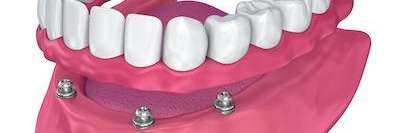 implant supported dentures