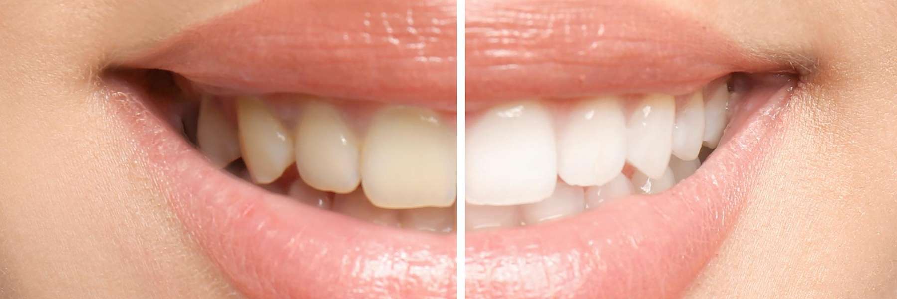 before and after photos of discolored smile