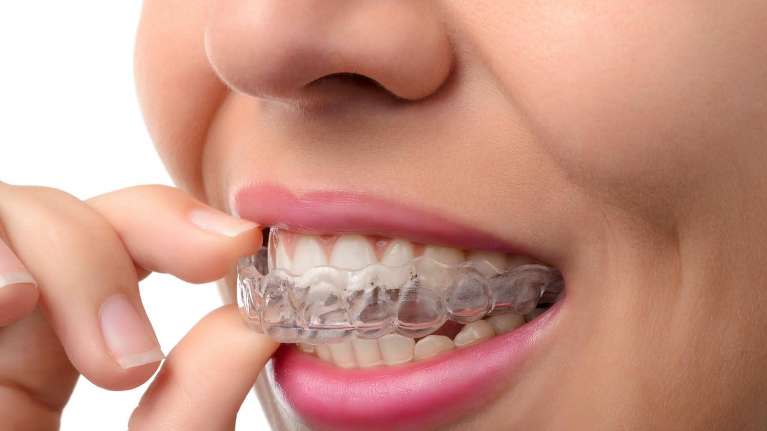 woodland hills woman using invisalign 