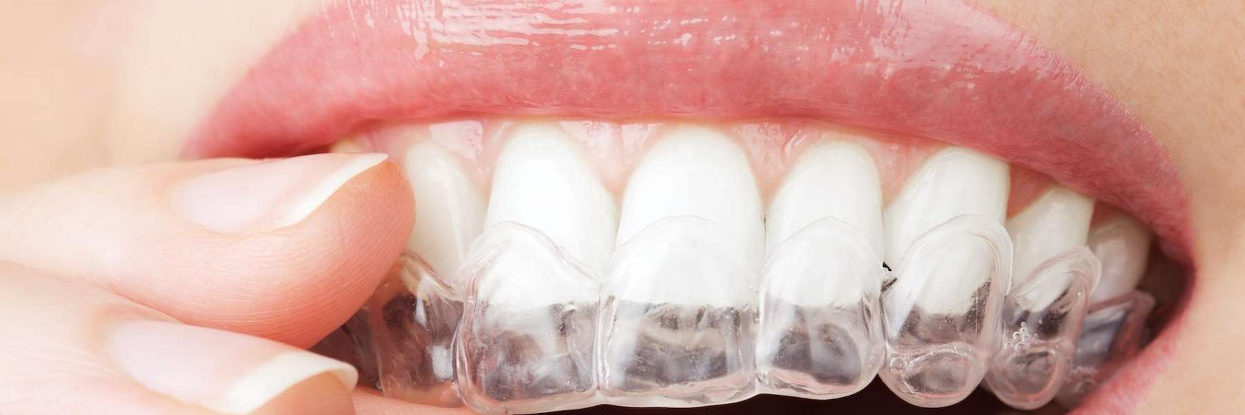 close up of woman using invisalign clear aligners from woodland hills dental office
