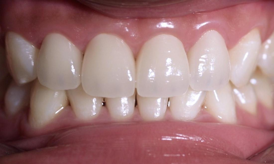 Veneers | Modern American Dentistry