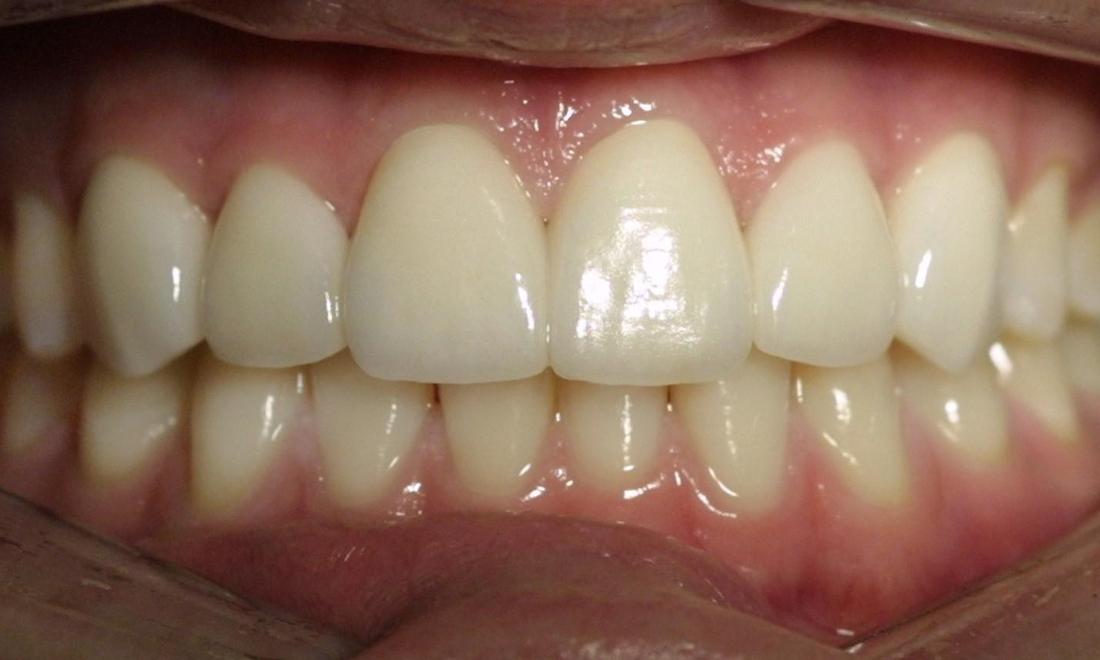 Veneers | Modern American Dentistry