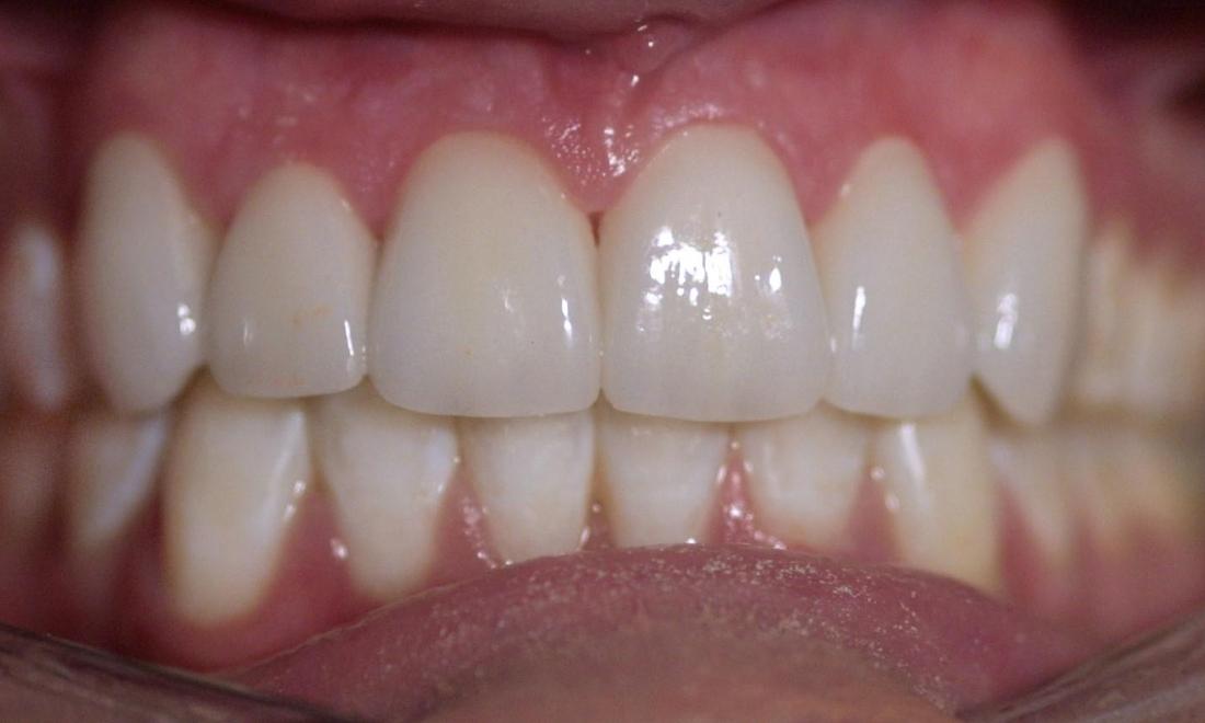 Dental Veneers | Modern American Dentistry