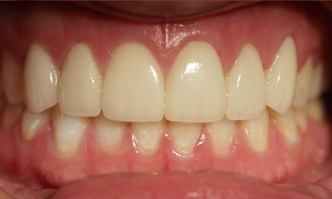 Veneers | Modern American Dentistry