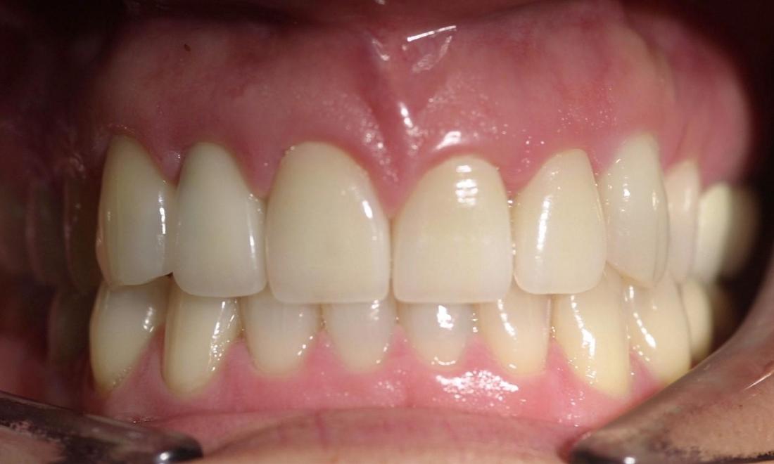 Bruxism Patient After | Modern American Dentistry