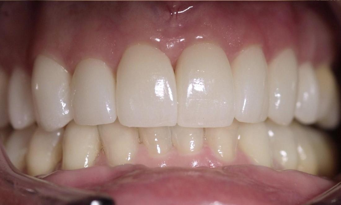 smile after veneers and bleaching