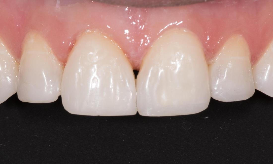 Teeth Whitening After | Modern American Dentistry