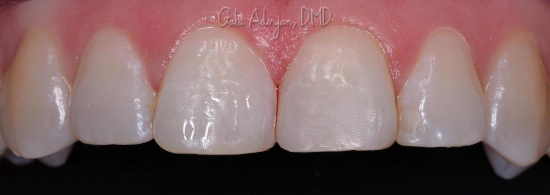 Cosmetic Bonding | Modern American Dentistry