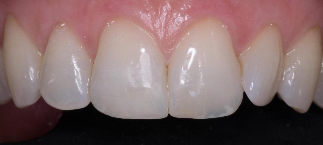 Esthetic Bonding | Modern American Dentistry