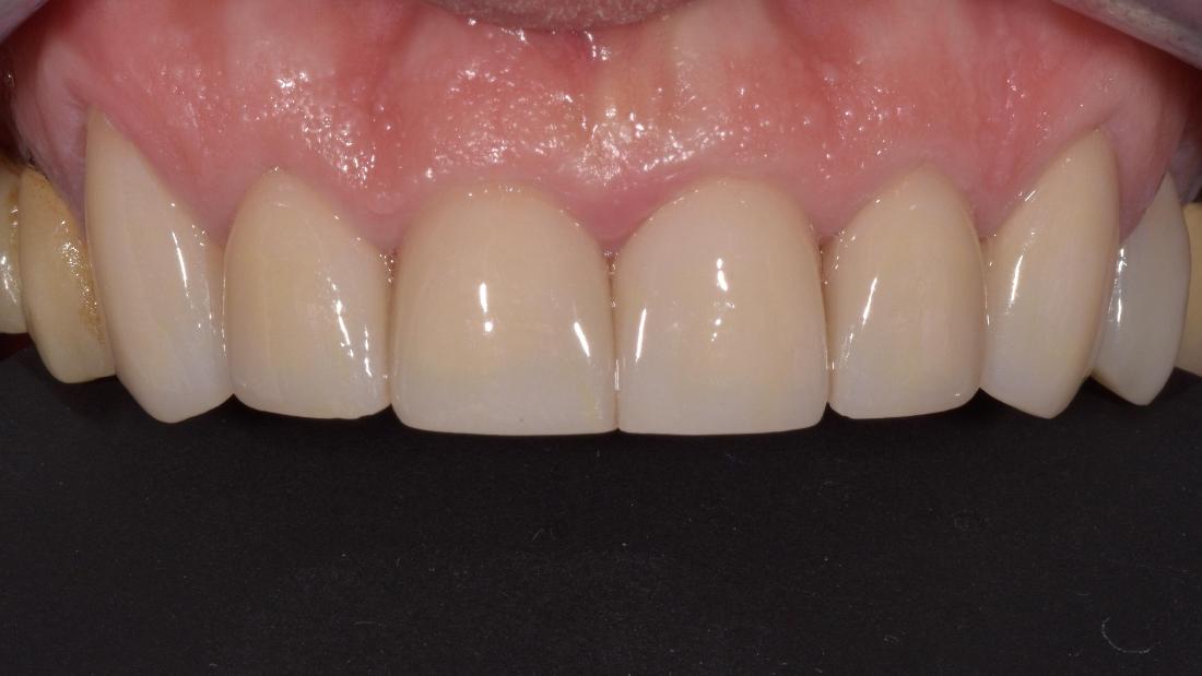 new natural-looking modern crowns