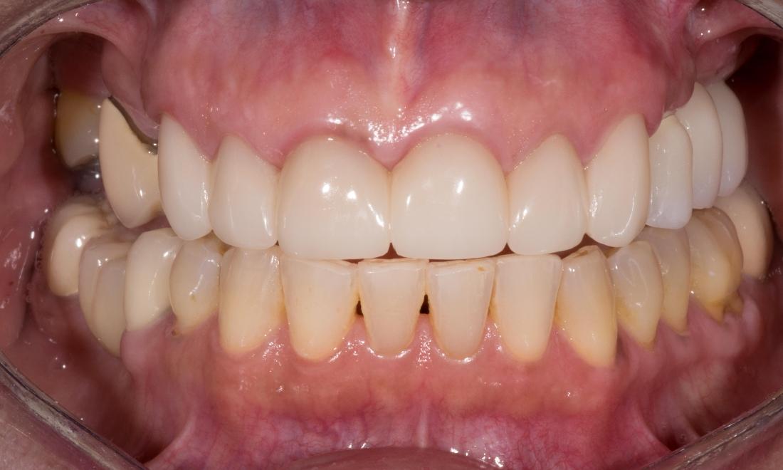 missing teeth replaced by implant-supported bridge