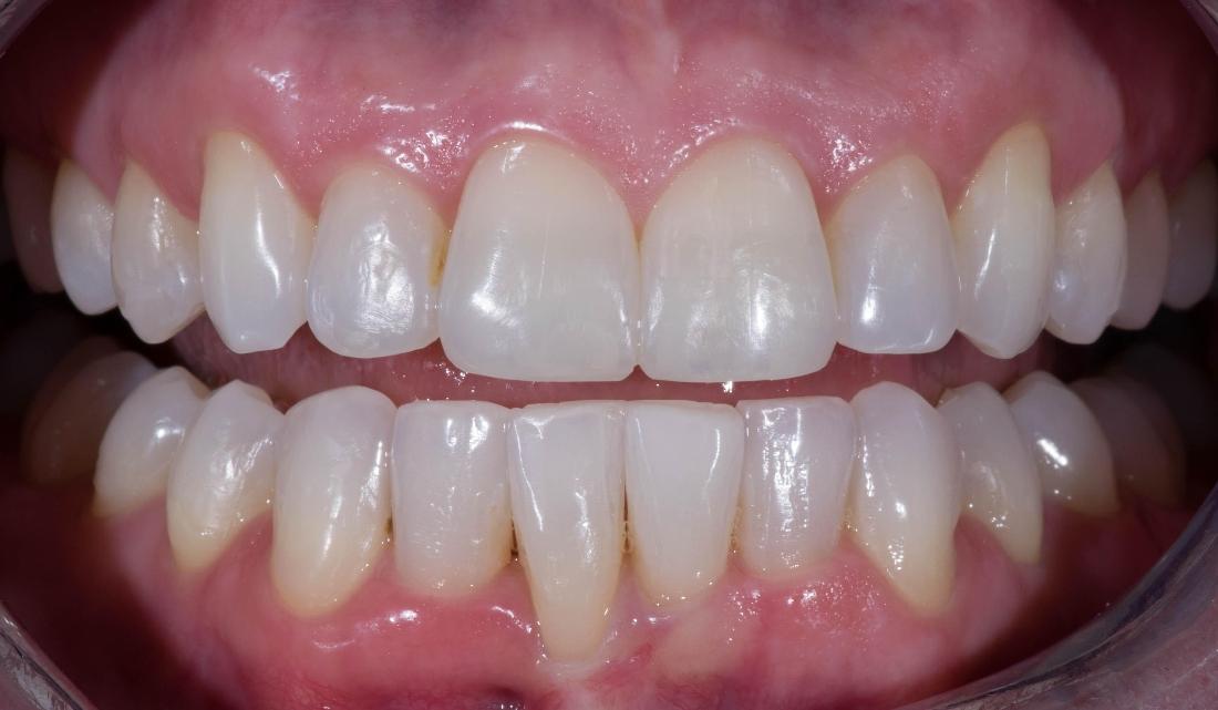 Invisalign Before and After | Modern American Dentistry