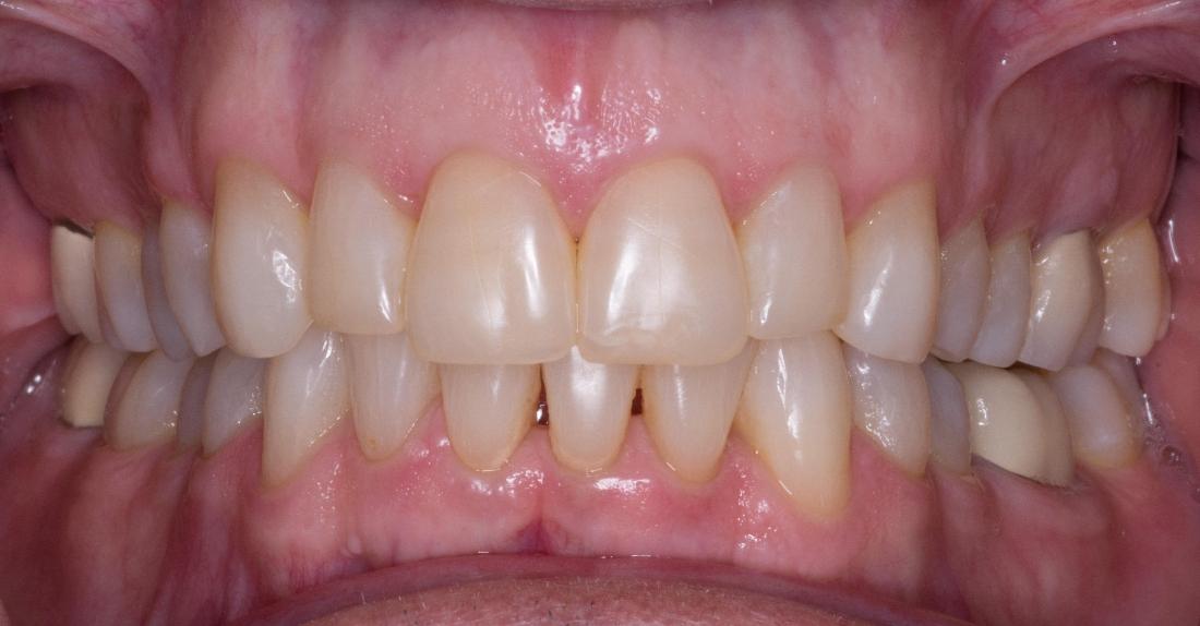 Invisalign | Modern American Dentistry