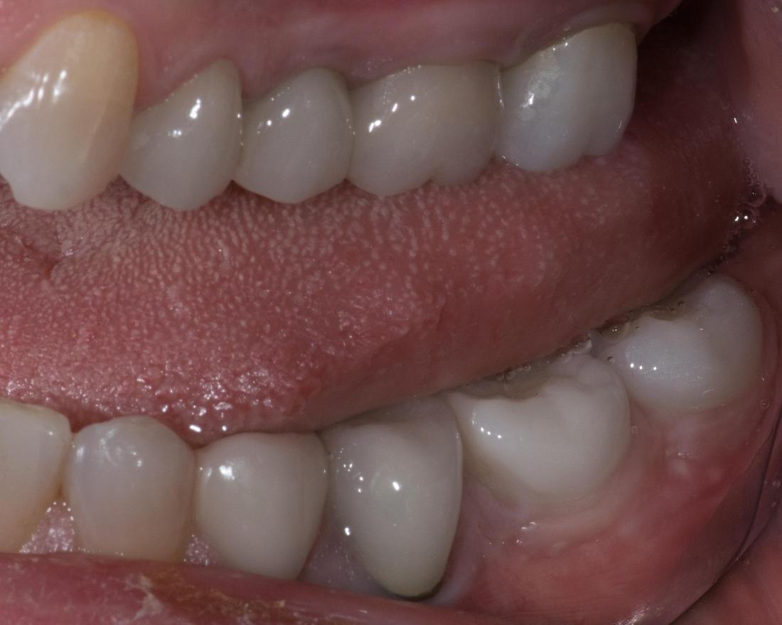 Molar Implants | Modern American Dentistry