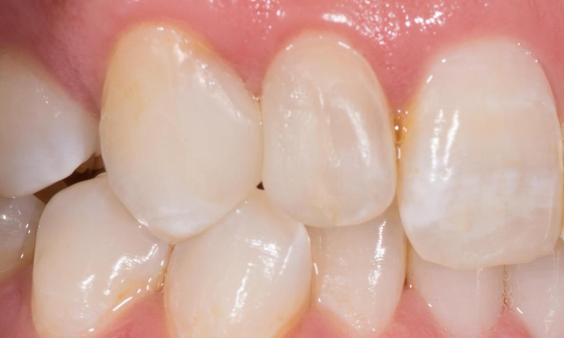 close up of bright teeth after restoration