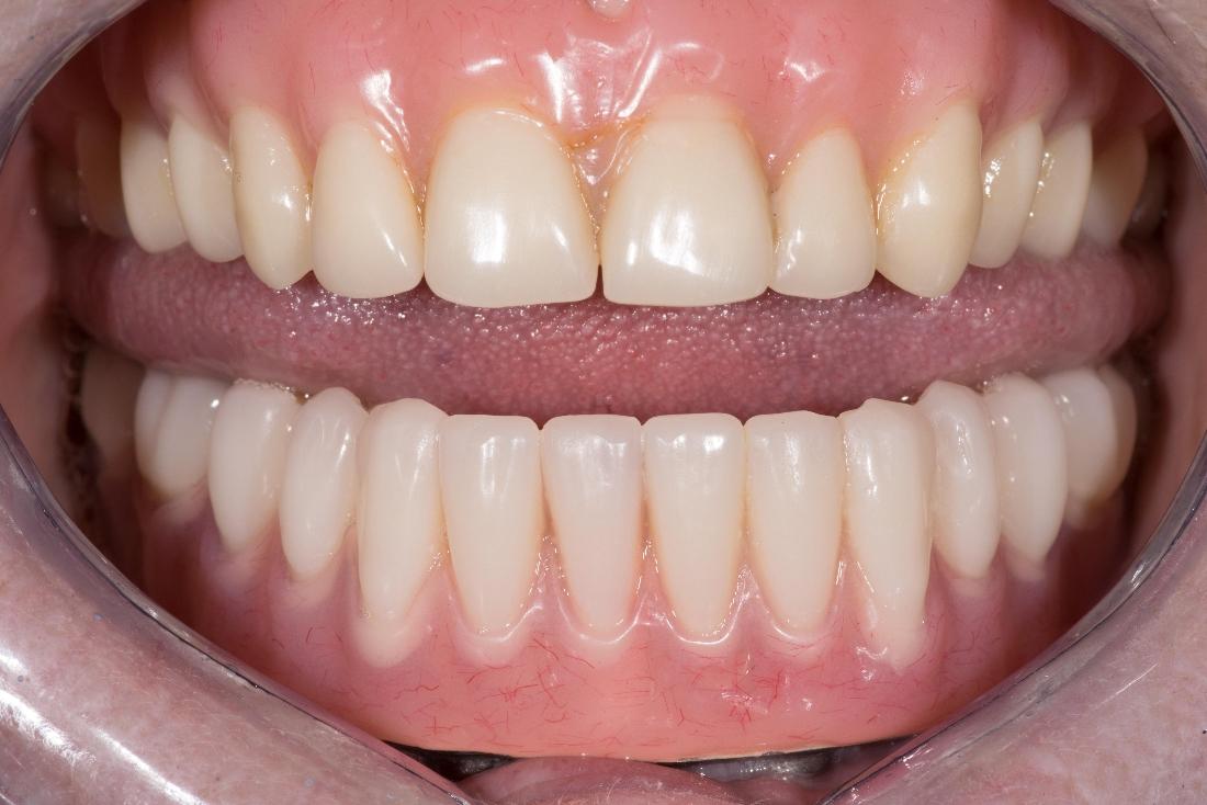 new implant supported implants for bottom teeth
