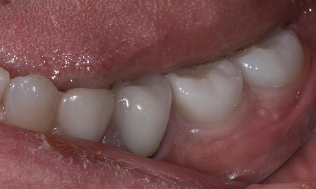 Molar Implants | Modern American Dentistry
