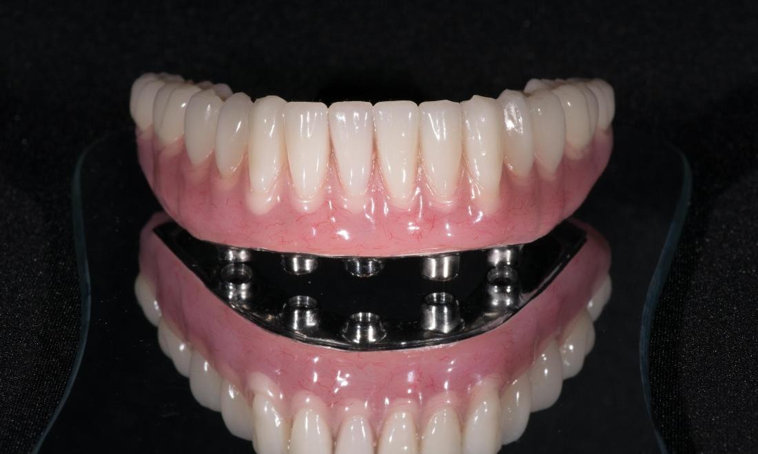 Implant supported dentures