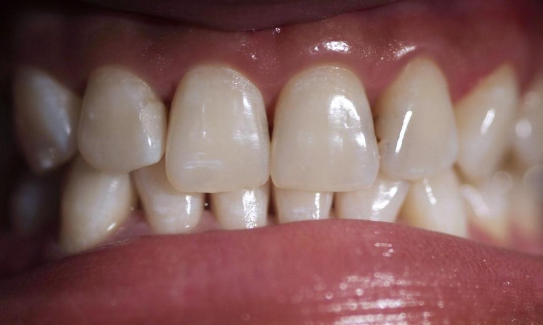 Veneers | Modern American Dentistry