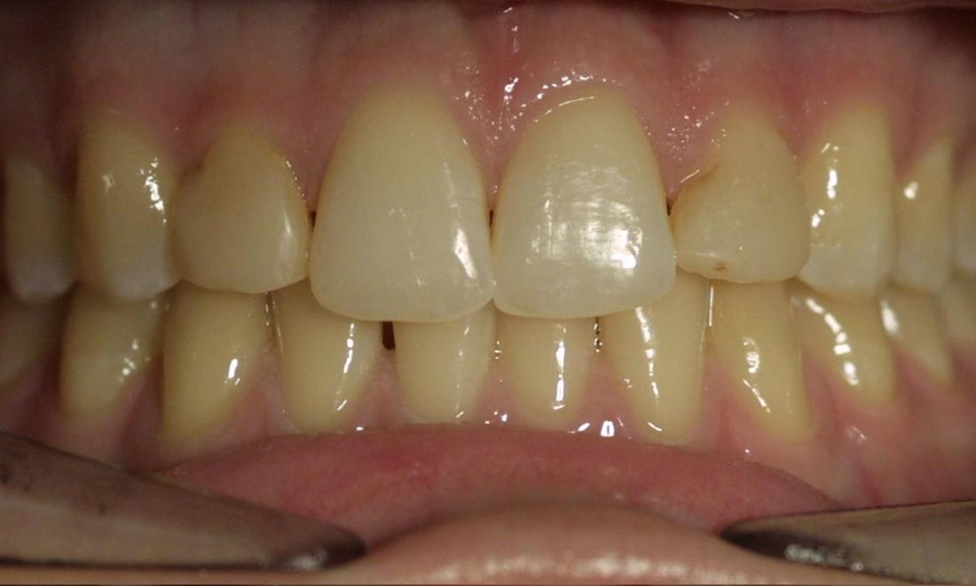 Veneers | Modern American Dentistry