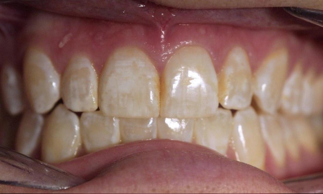 Dental Veneers | Modern American Dentistry