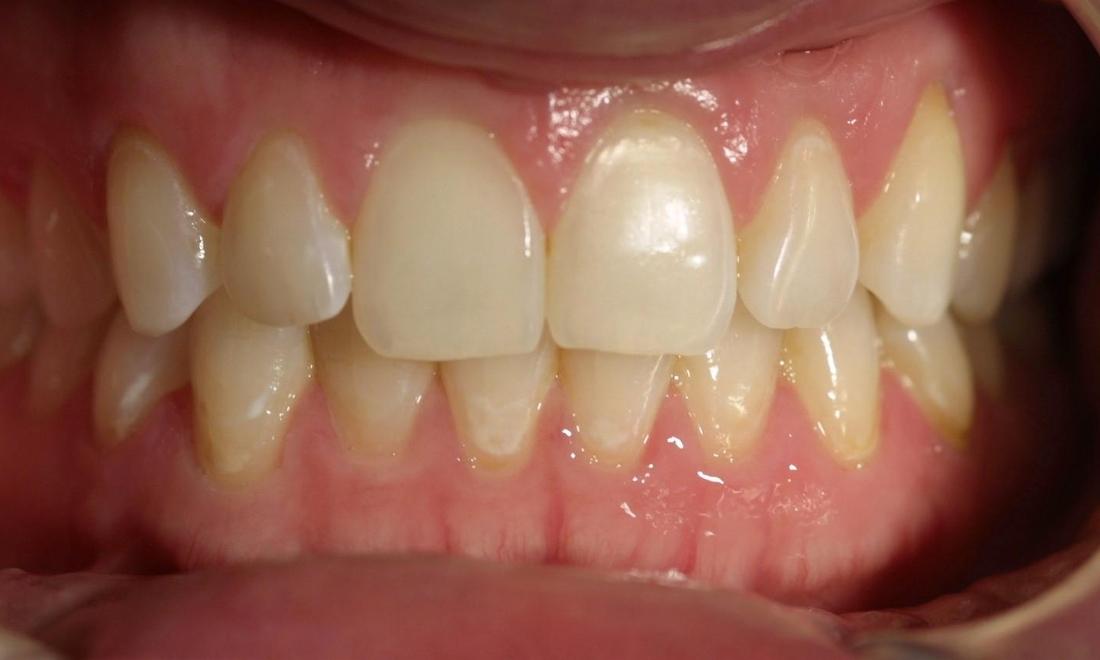 Veneers | Modern American Dentistry