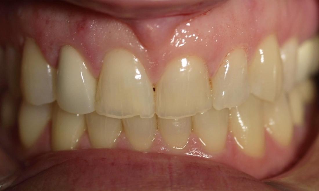 Bruxism Patient Before | Modern American Dentistry
