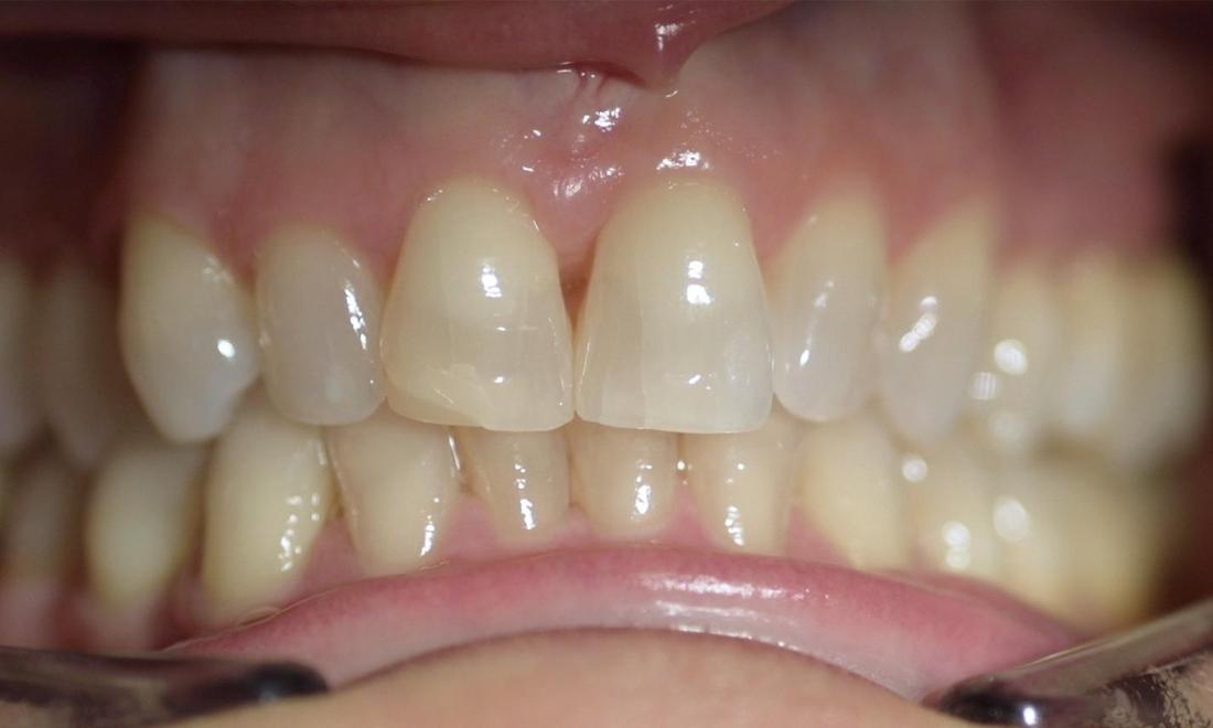 patient's discolored smile before veneers