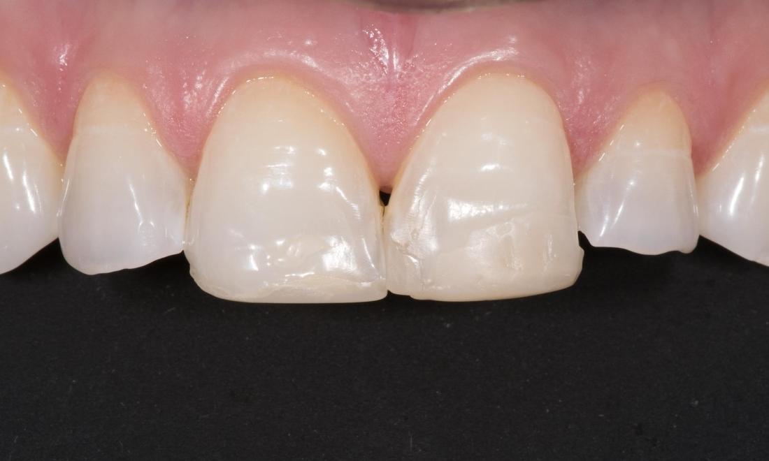 Teeth Whitening Before | Modern American Dentistry