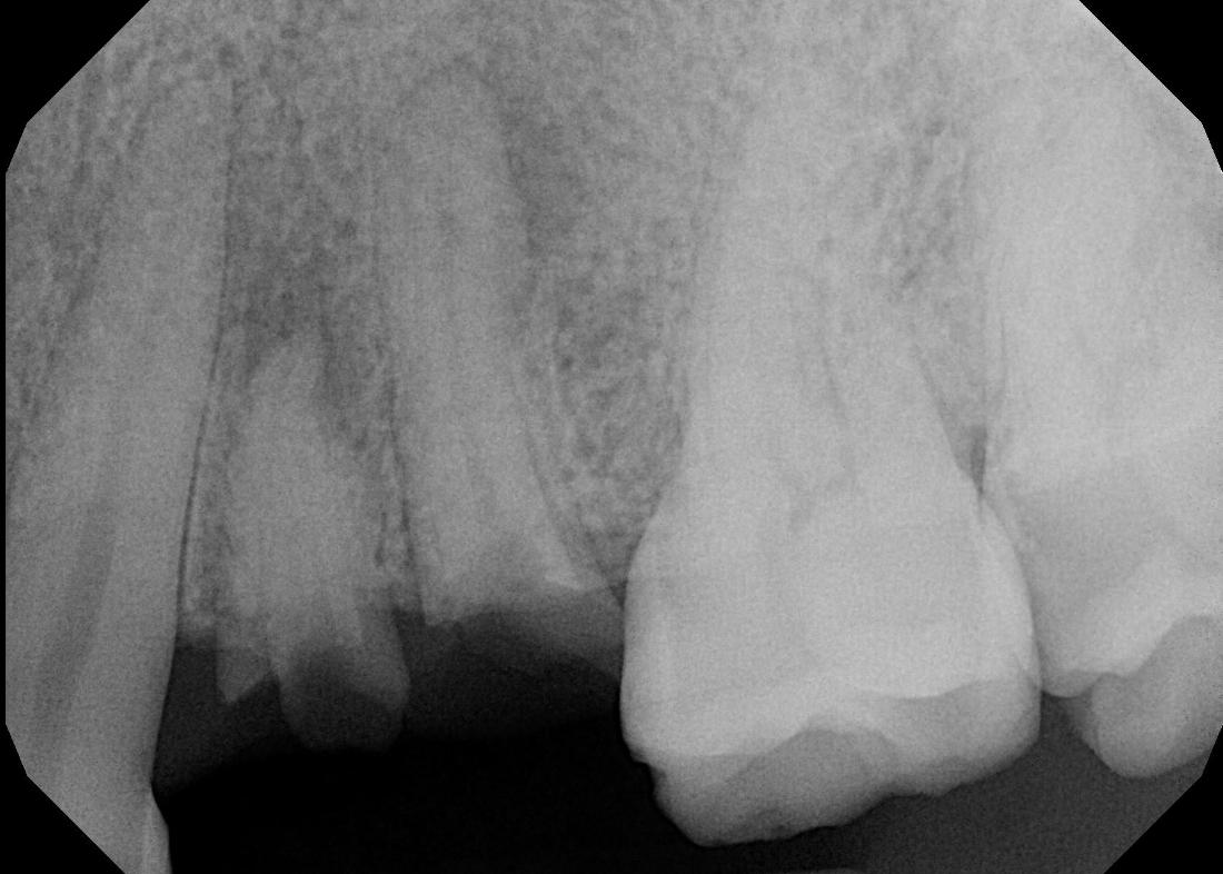 Dental Implants | Modern American Dentistry