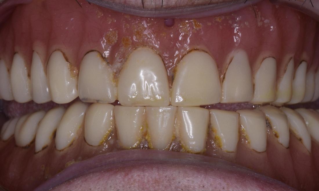 Dentures | Modern American Dentistry