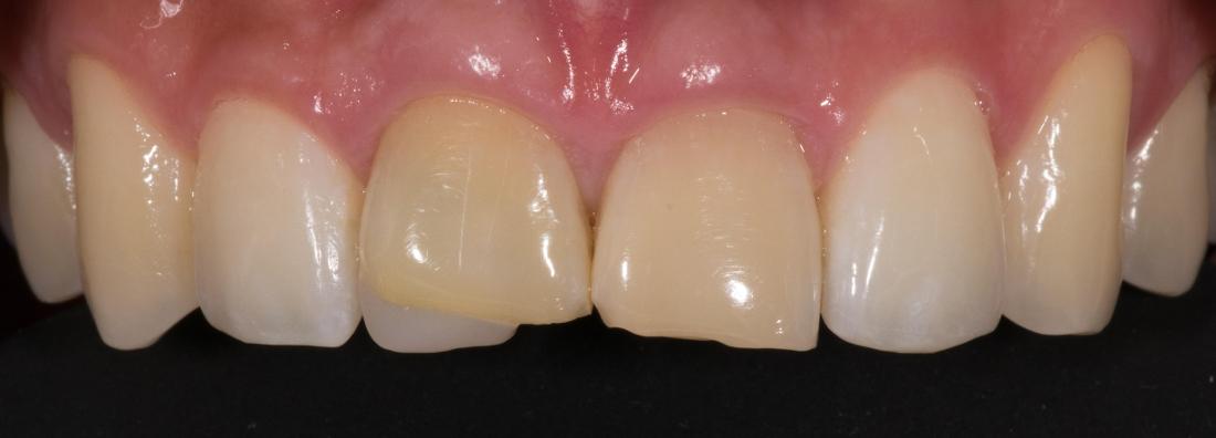 Discolored and crooked front teeth 