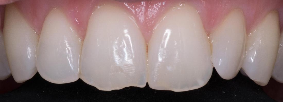 Esthetic Bonding | Modern American Dentistry