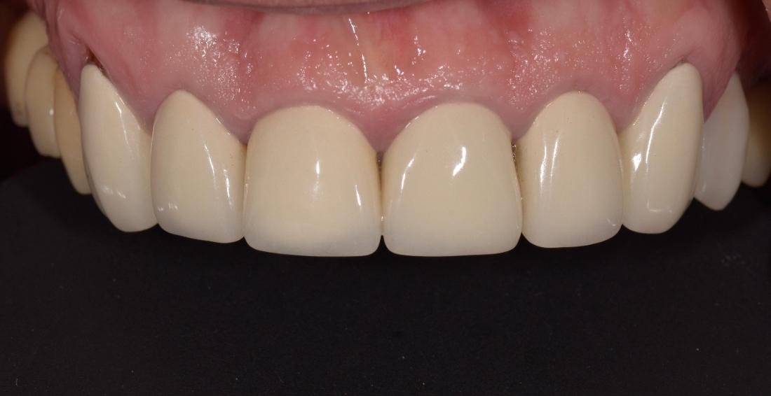 Fake-looking crowns