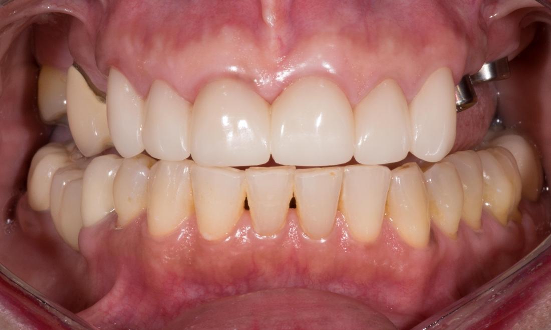 dental implants in back of teeth before bridge