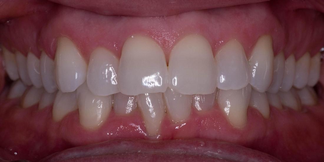 Invisalign Before and After | Modern American Dentistry