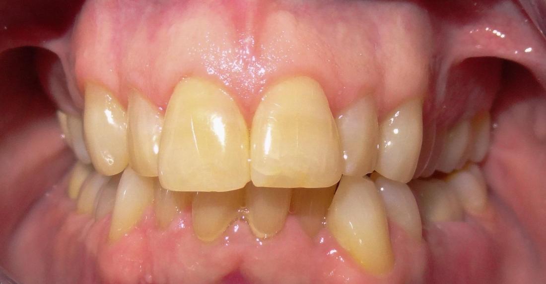 Invisalign | Modern American Dentistry