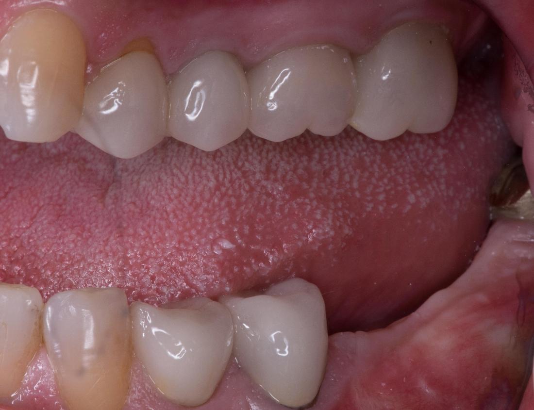 Molar Implants | Modern American Dentistry