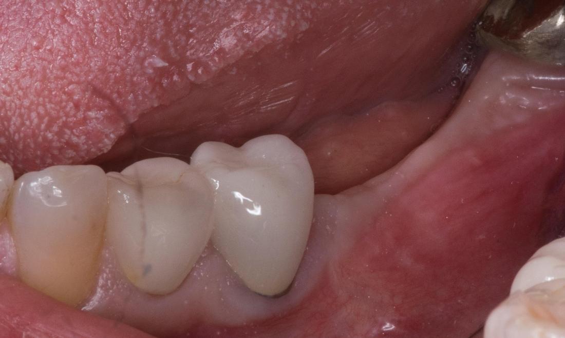 Molar Implants | Modern American Dentistry
