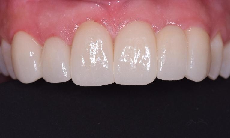 Bridge-and-Missing-Front-Teeth-After-Image