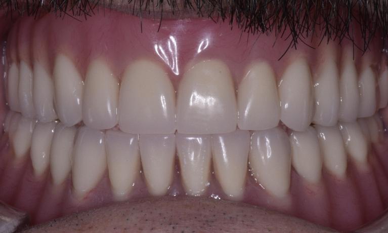 Dentures-After-Image