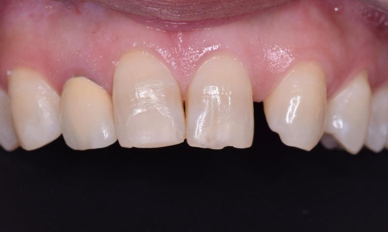 Bridge-and-Missing-Front-Teeth-Before-Image